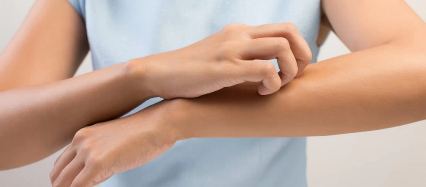 Χρόνια αυθόρμητη κνίδωση: Tι είναι η φαγούρα που «κυριεύει» το σώμα